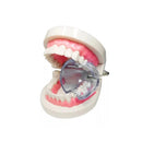 Abridor de Boca Lysanda - Isolamento Relativo com Conforto e Eficiência - Lysanda